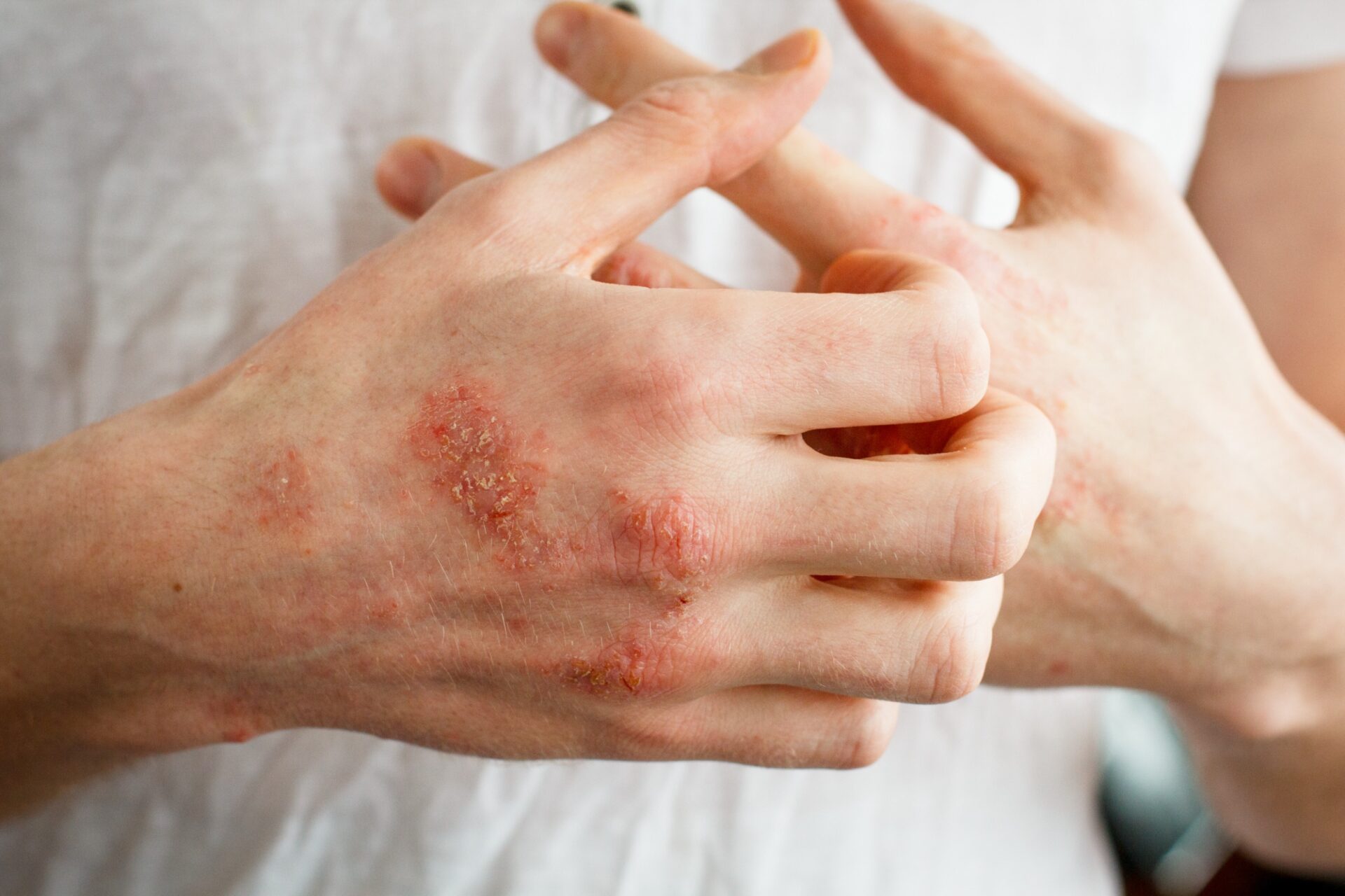 A person with a lot of red spots on their hands