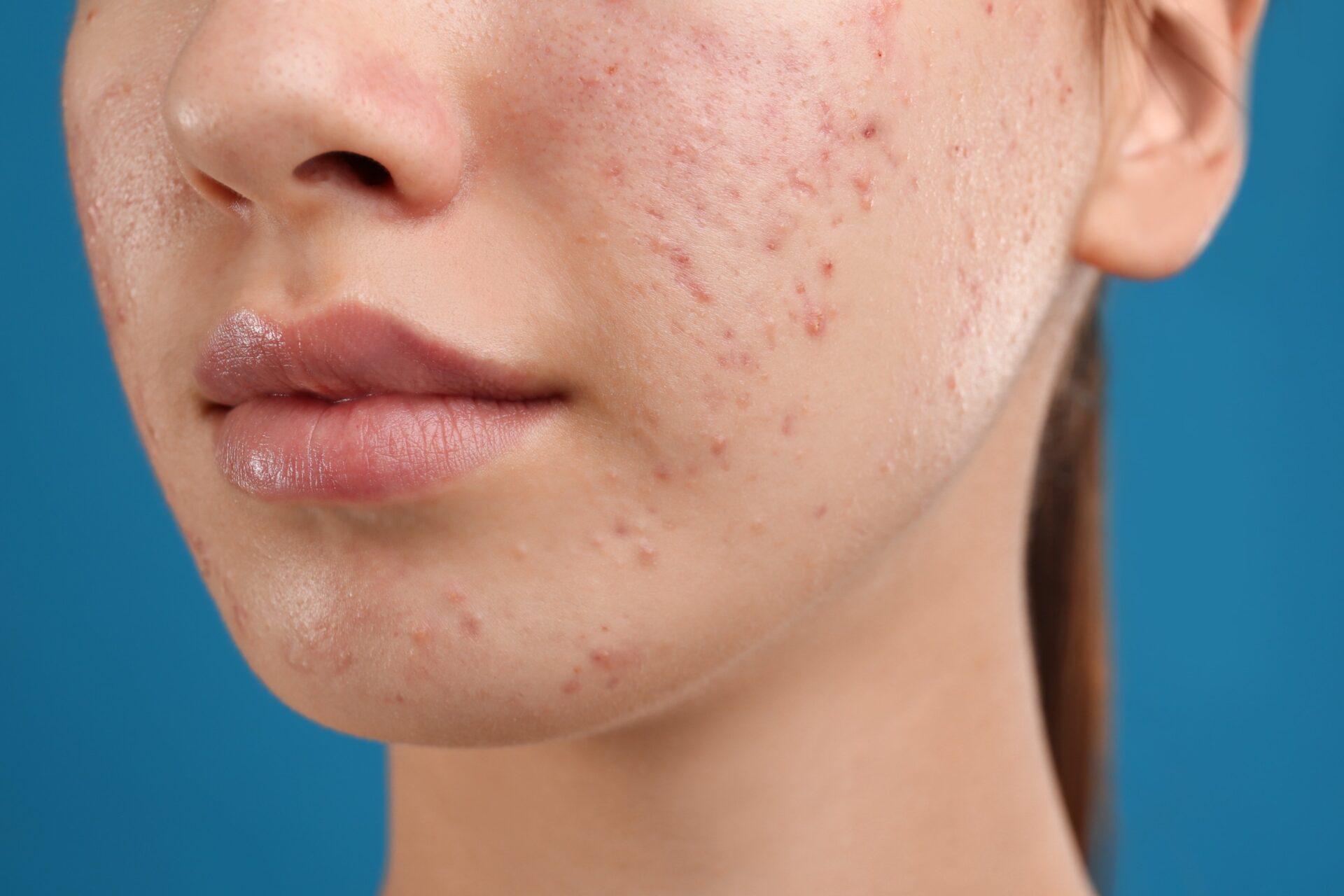 A woman with acne on her face